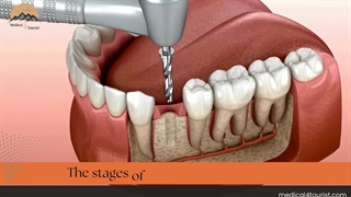 کاشت ایمپلنت دندان