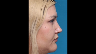 قبل و بعد عمل زیبایی بینی