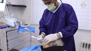 انجام یک واحد ایمپلنت دندان به روش پانچ