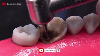 هزینه پرکردن و ترمیم دندان