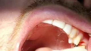 ایمپلنت بدون جراحی