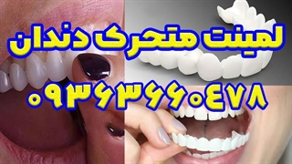 لمینت متحرک دندان تراست اسمایل دوفک