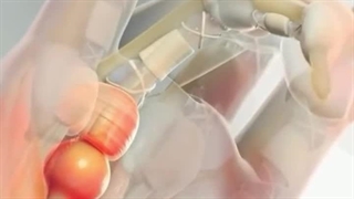 انگشت ماشه ای ، دکتر بهرام بدوحی متخصص ارتوپد کلینیک درد مهرگان. کلینیک دندانپزشکی
