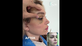 جراحة شد الوجه العمیق فی إیران