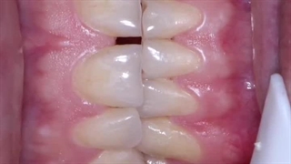 بهترین دکتر بلیچینگ دندان در بوشهر- در بوشهر