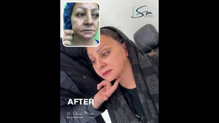 جراحة شد الوجه العمیق