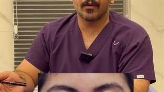 عمل زیبایی پتوز و بلفاروپلاستی چطور انجام میشود