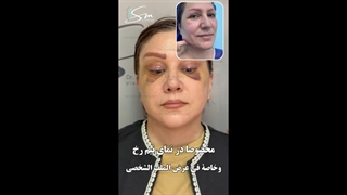 عملیة شد الوجه الکامل وتجمیل الأنف