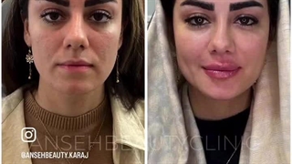 معجزه تزریق چربی به صورت