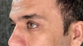 کاشت مو لیزری با اسکن سه بعدی در تهران