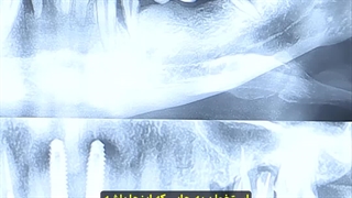 بیماری پریودنتال چیست؟