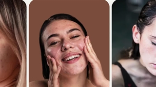 Clear Skin, Confident You: The Ultimate Acne Solution!