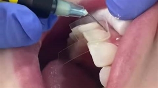 فرآیند کامپوزیت دندان؛ از طراحی تا نهایی‌سازی