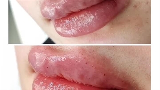 دکتر شادی مظلومی اکستنشن تاج دندان