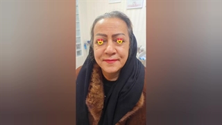 انجام لیفت صورت با نخ (3)