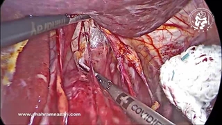 برش عضله مری(میوتومی) بلند در درمان آشالازی