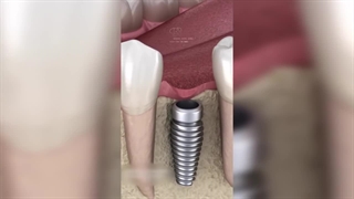 کاشت ایمپلنت دندان برای همیشه!