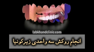 روکش زیر کونیا