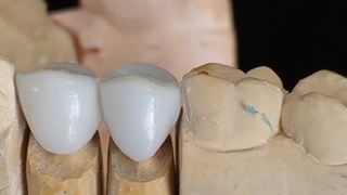 طراحی دو واحد ایمپلنت دندان در دندانپزشکی گلدن ایمپلنت