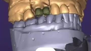 ترکیب دیجیتال و هنر دست در دندانپزشکی گلدن ایمپلنت