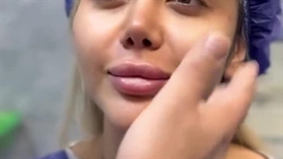 لیفت شقیقه در تهران