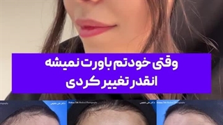 رینوپلاستی با  نتیجه فوق العاده در تهران
