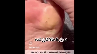 خرید اسپری رفع ترک کف پا راکو ماسکده
