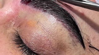 نمونه کاشت ابرو در کلینیک مانا