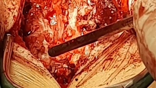 فیلم جراحی تنگی کانال نخاعی کمر