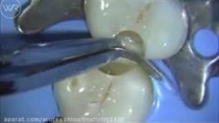 نوار ماتریکس دندانپزشکی چیست و چه کاربردی دارد؟