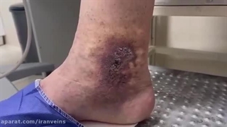 زالو درمانی برای واریس