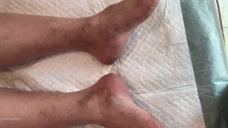 واریس مچ پا