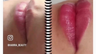 نمونه کارهای تزریق فیلر لب در مرکز لیزر حریرا