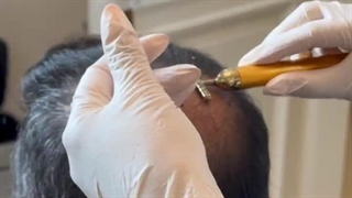 اگزوزوم تراپی نوین ترین روش درمان ریزش مو