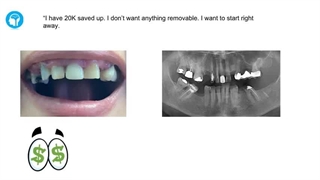 آیا افراد دیابتی می‌توانند ایمپلنت دندان انجام دهند؟