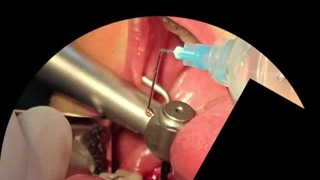 کاشت دندان تخصصی در تهران در کلینیک دکتر حمید پورصادقی