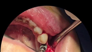 کاشت دندان تخصصی در کلینیک دکتر حمید پورصادقی