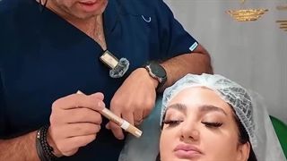 لیفت با نخ سیلوئت توسط دکتر علی پرتویی نژاد