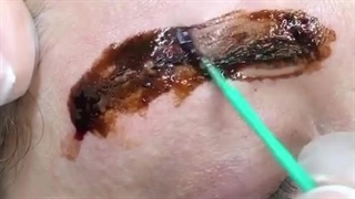 ریموو تتو سالن زیبایی آنارام مشهد (1)