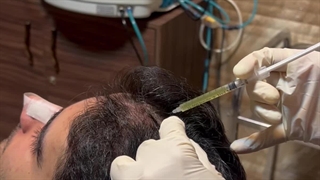 پی ار پی و مزوتراپی در اصفهان کلینیک تخصصی آفتاب