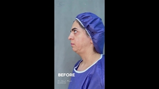 جراحی لیفت صورت و گردن و عمل بینی - دو ماه و نیم بعد از عمل