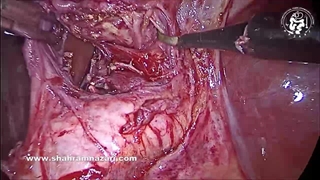 یک مورد چالش برانگیز از کوله سیستکتومی لاپاراسکوپی: کوله سیستیت فیبروتیک مزمن حاد در زمینه التهاب مزمن؛ هیدروپس کیسه صفرا