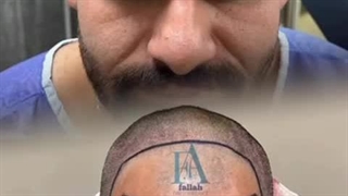 کاشت مو سمیه فلاح در شیراز