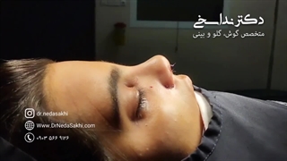 بلافاصله پس از عمل بینی