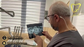 انجام ایمپلنت دندان در کلینیک لبخند