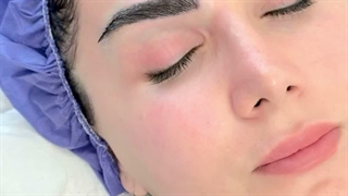 کاشت ابرو ، راهی به سوی ابروهایی پر پشت و طبیعی