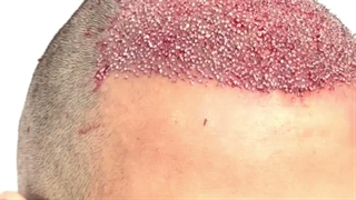کاشت تخصصی مو در کلینیک زیبایی سینا
