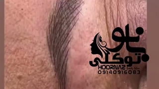میکروبلیدینک در یزد