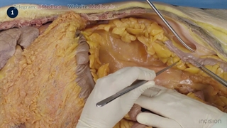 1 Abdominal Exposure - Left Medial Visceral Rotation