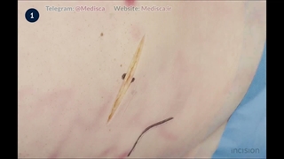 9 Abdominal Wall Incision - Muscle Splitting